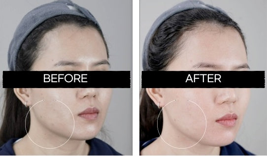 High Intensity Focused Ultrasound (HIFU)