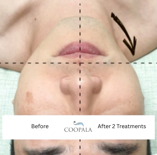 High Intensity Focused Ultrasound (HIFU)