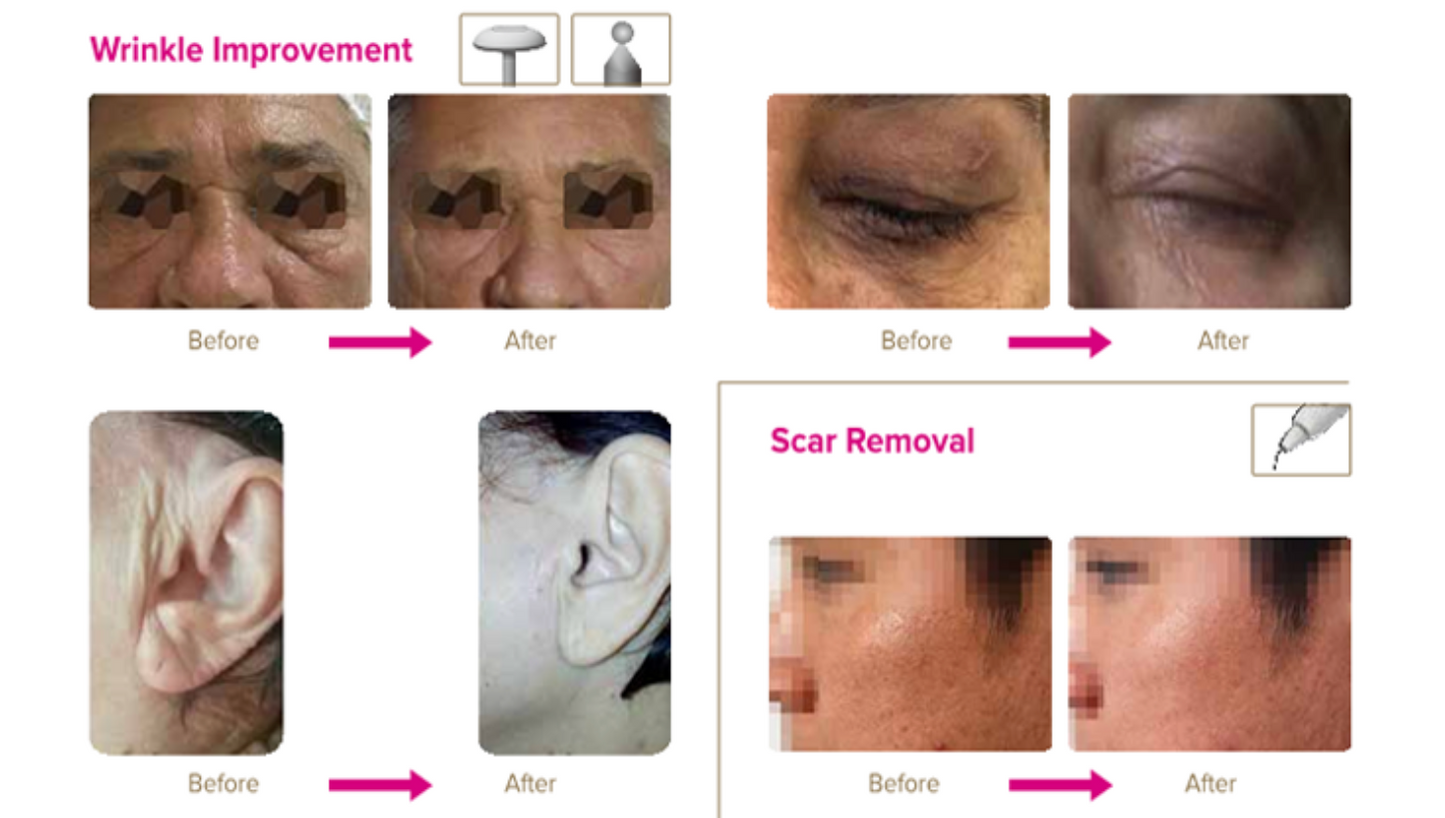 Vegaplax Plasma System