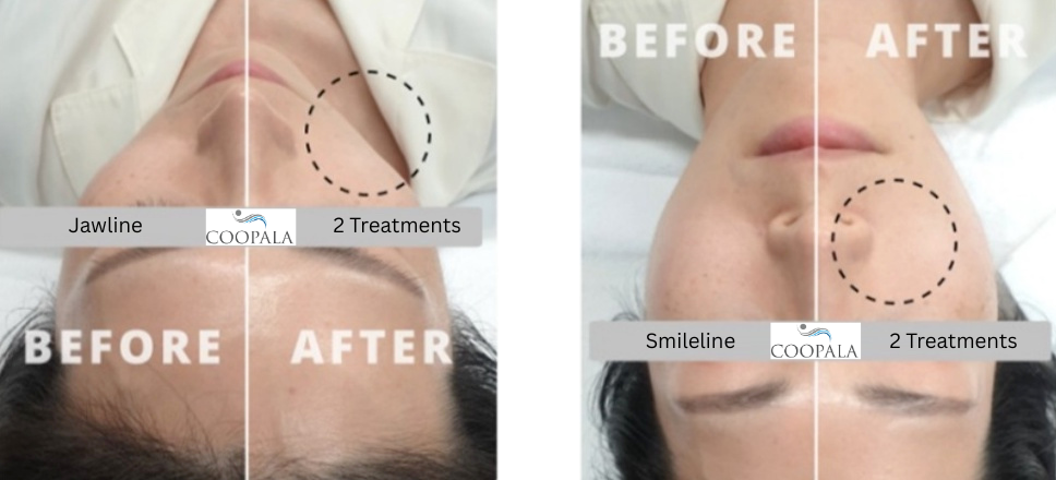 High Intensity Focused Ultrasound (HIFU)