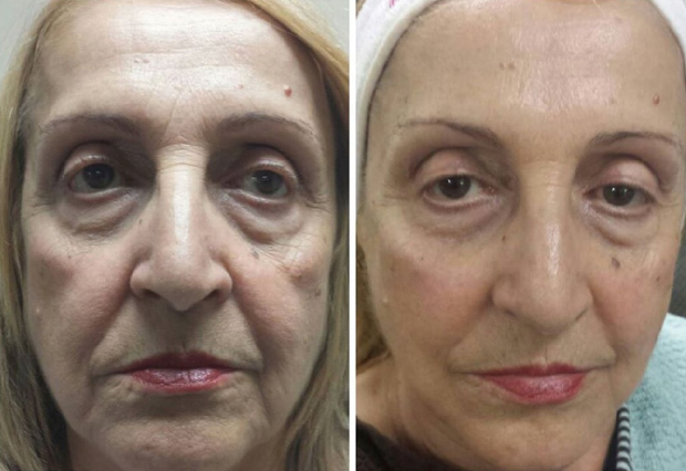 Coopala Facial Rejuvenation Machine: Advanced Skin Renewal System