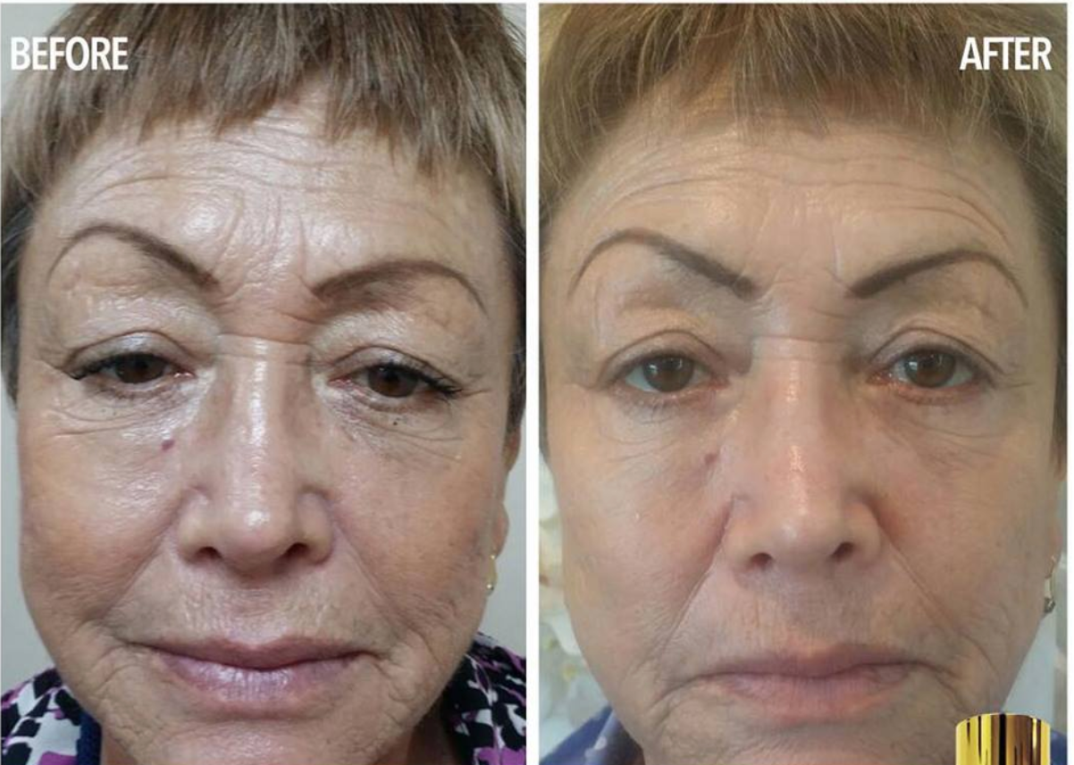 Coopala Facial Rejuvenation Machine: Advanced Skin Renewal System