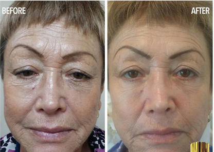 Coopala Facial Rejuvenation Machine: Advanced Skin Renewal System