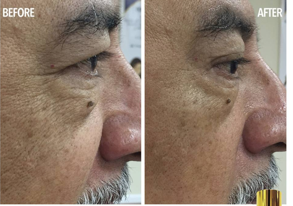 Coopala Facial Rejuvenation Machine: Advanced Skin Renewal System