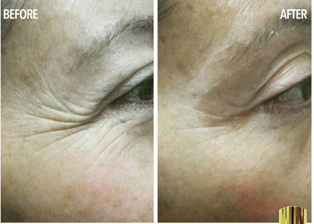 Coopala Facial Rejuvenation Machine: Advanced Skin Renewal System