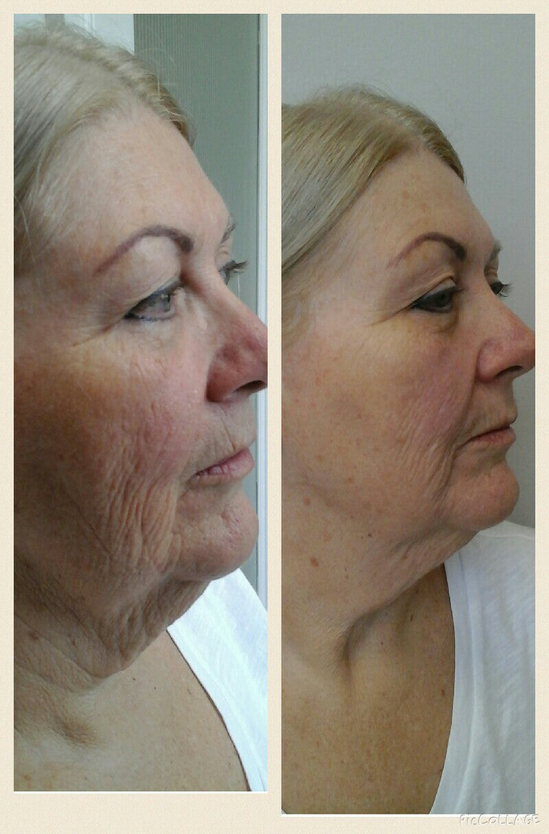 Coopala Facial Rejuvenation Machine: Advanced Skin Renewal System
